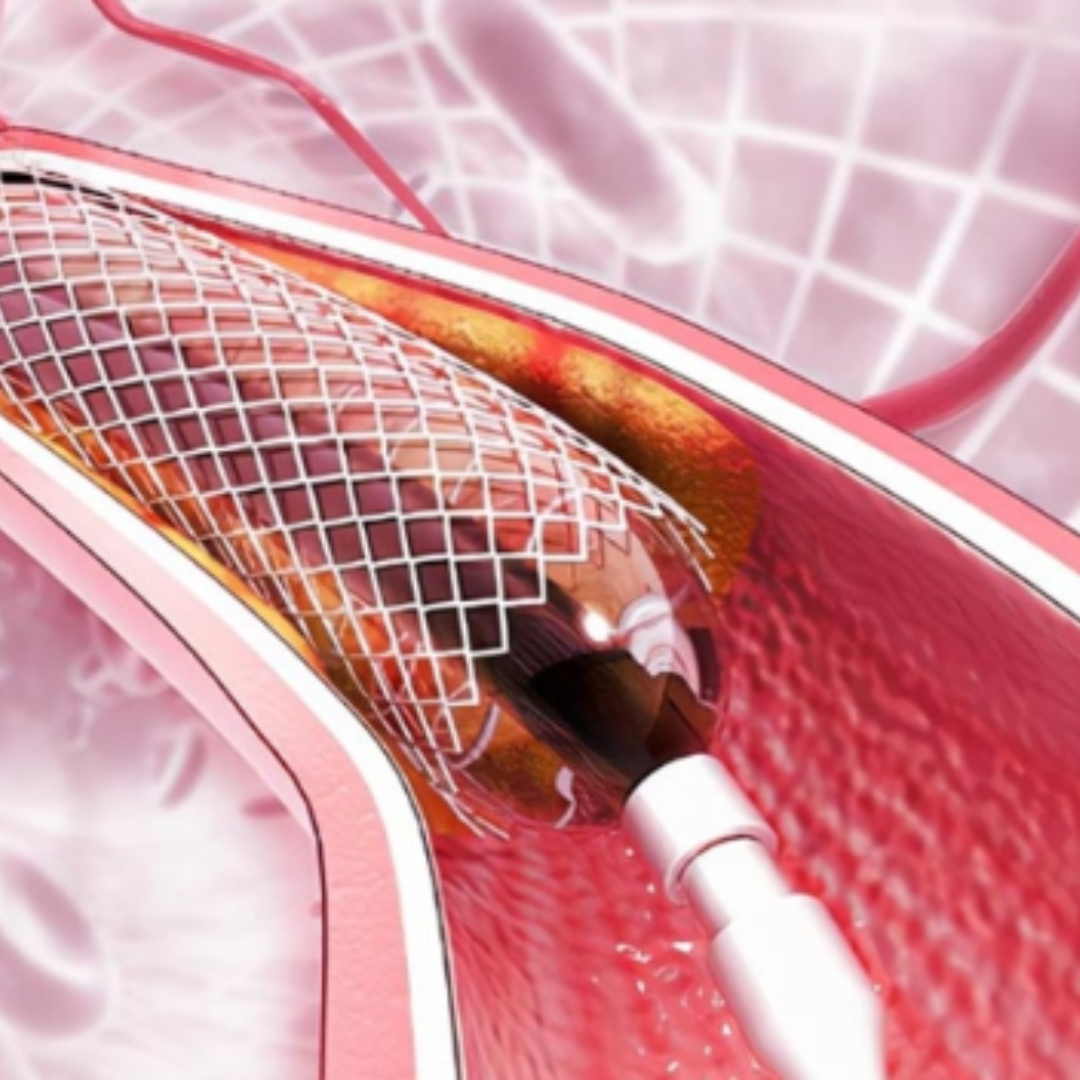 cateterismo cardíaco