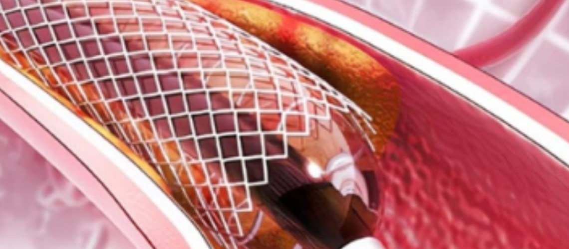 cateterismo cardíaco